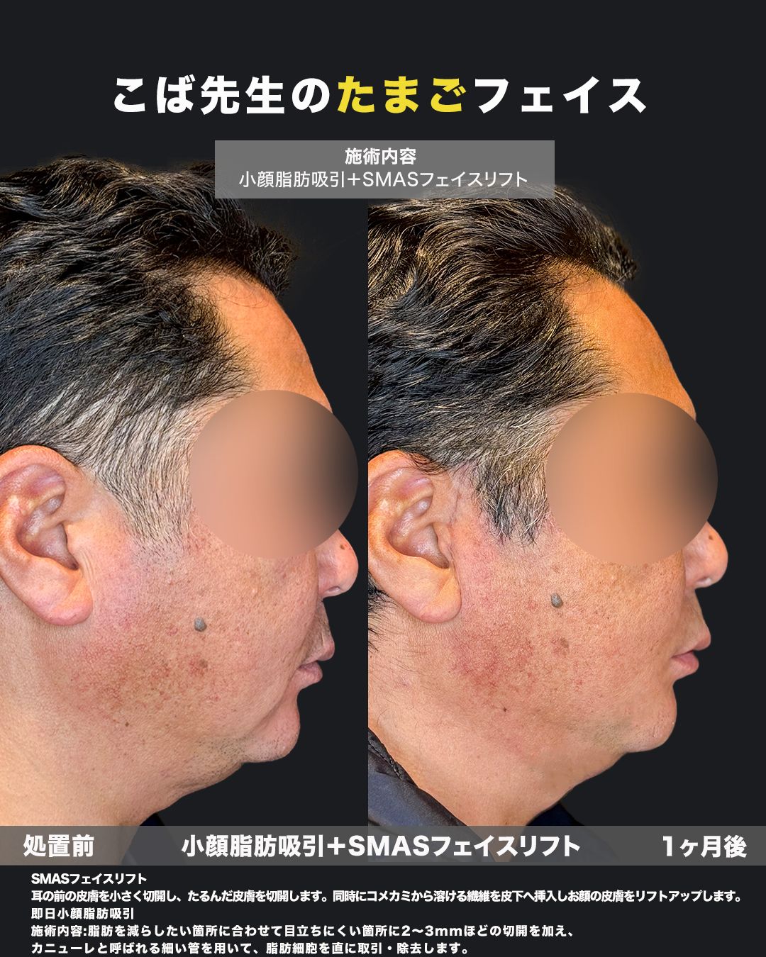 小顔脂肪吸引とSMASフェイスリフトの症例写真。男性の横顔の処置前と1ヶ月後の比較