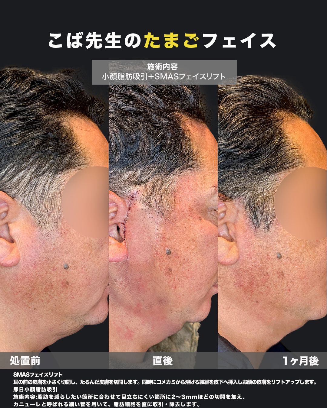 小顔脂肪吸引とSMASフェイスリフトの経過写真。男性の横顔の処置前・直後・1ヶ月後の3段階比較