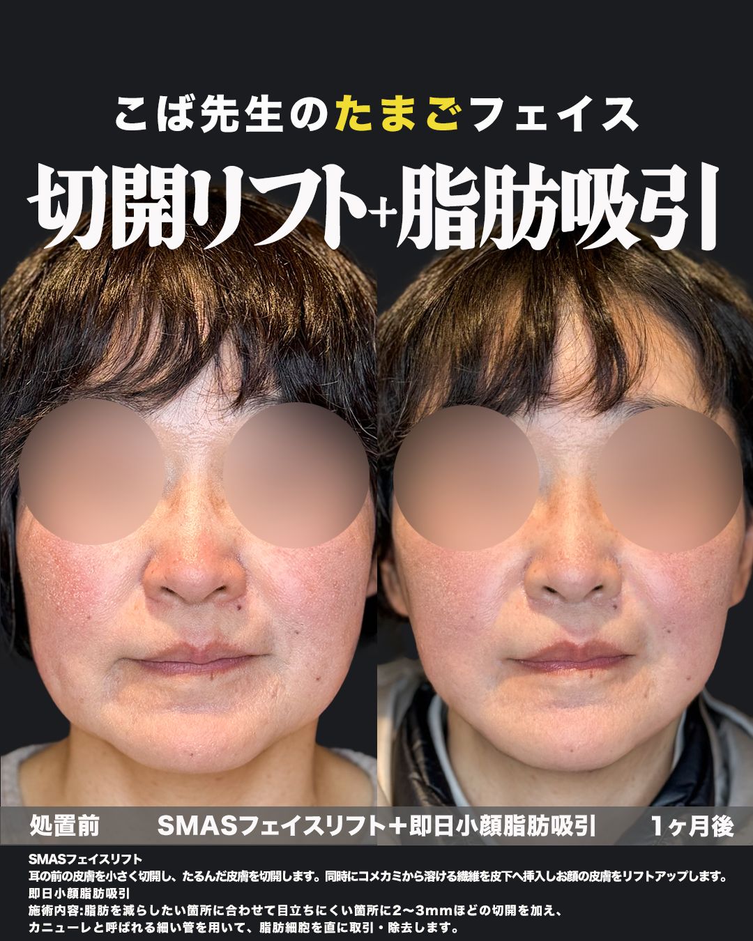 SMASフェイスリフトと即日小顔脂肪吸引の施術前と1ヶ月後を正面から比較した症例写真
