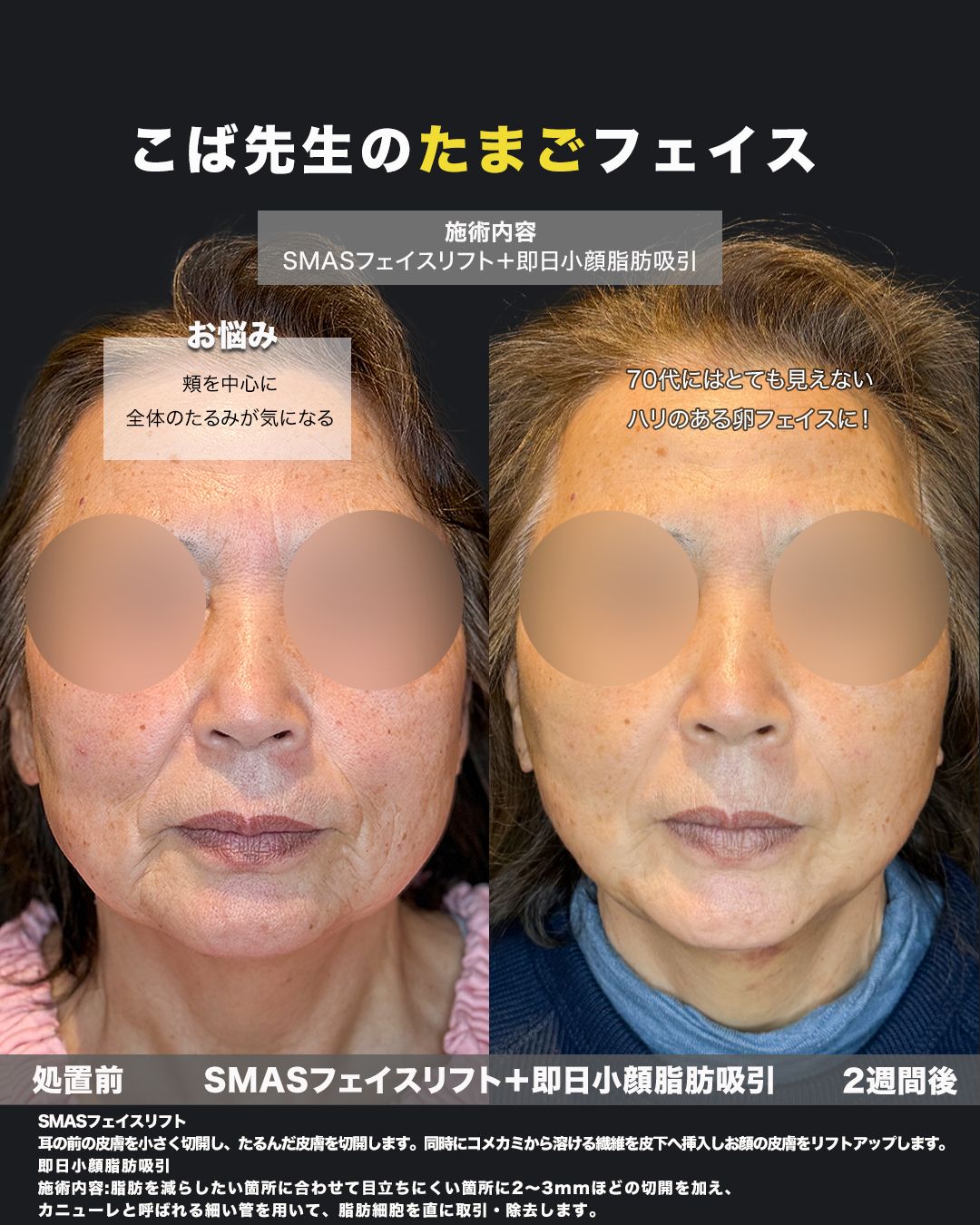 SMASフェイスリフトと小顔脂肪吸引の正面ビフォーアフター写真