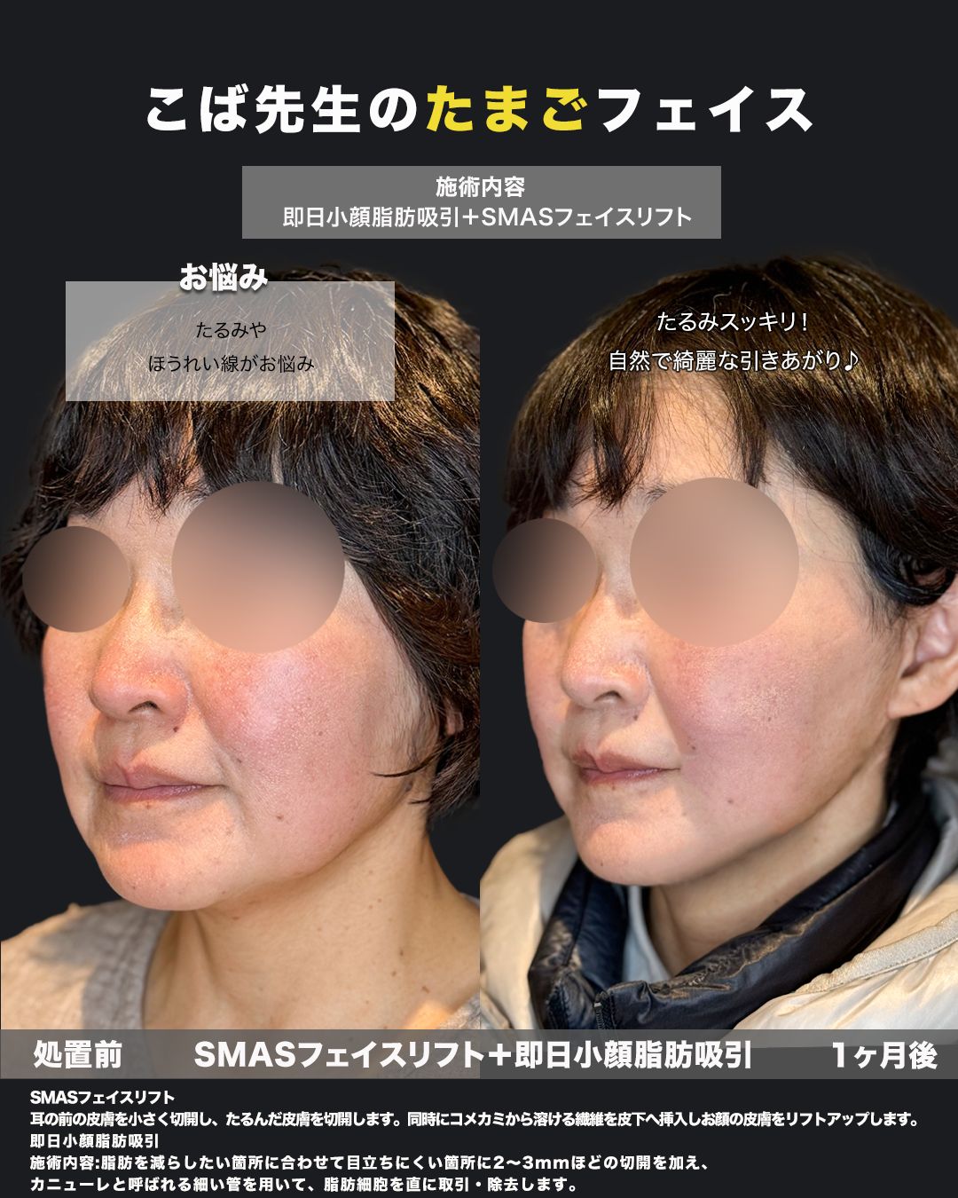 SMASフェイスリフトと即日小顔脂肪吸引の施術前と1ヶ月後を斜めから比較した症例写真