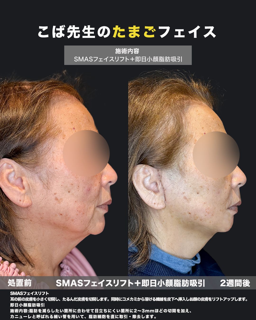 SMASフェイスリフトと小顔脂肪吸引の横顔ビフォーアフター写真