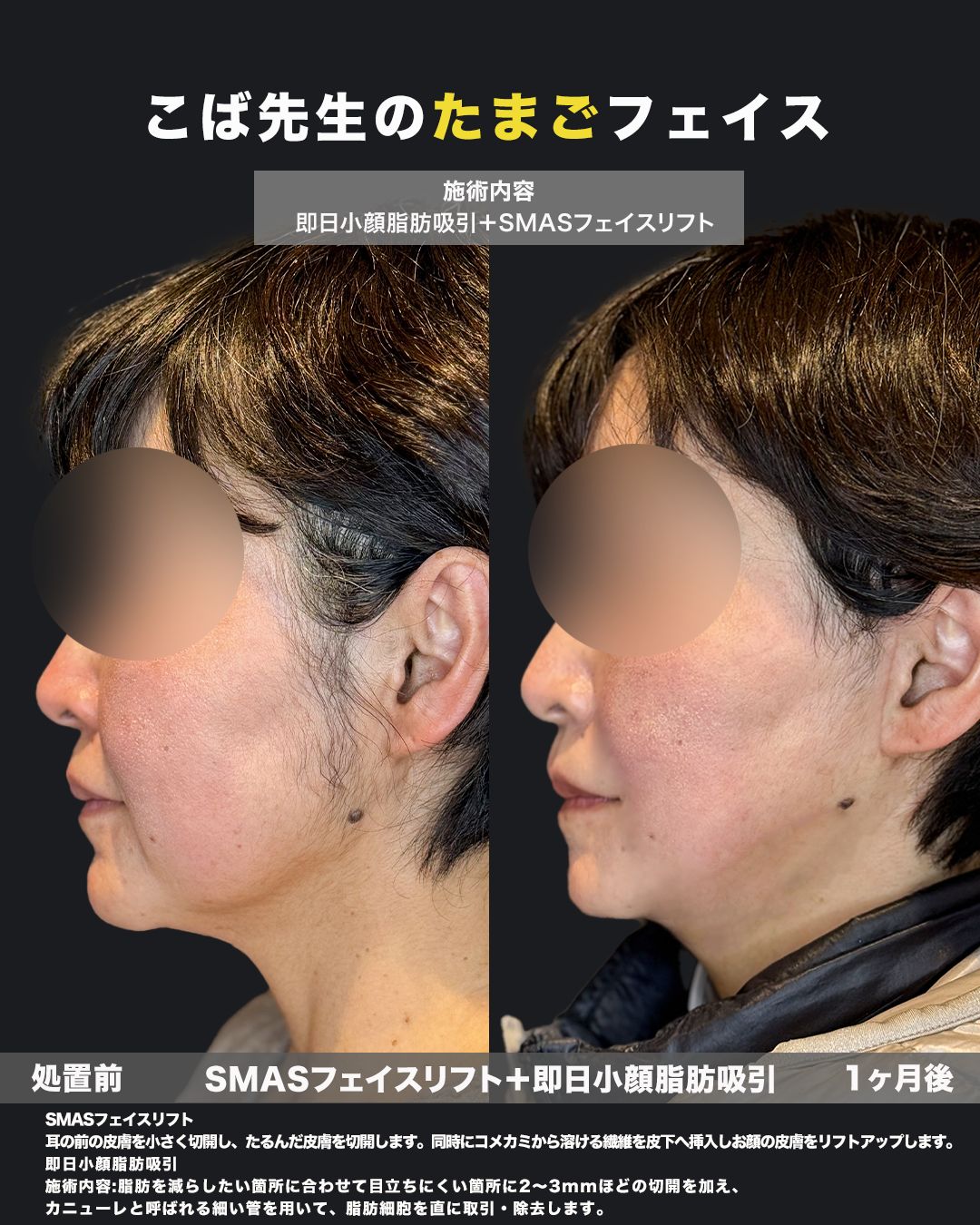 SMASフェイスリフトと即日小顔脂肪吸引の施術前と1ヶ月後を横顔で比較した症例写真