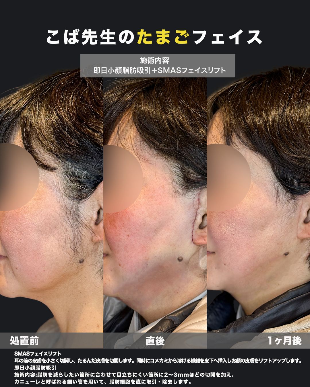 SMASフェイスリフトと即日小顔脂肪吸引の施術前・直後・1ヶ月後を横顔で比較した症例写真
