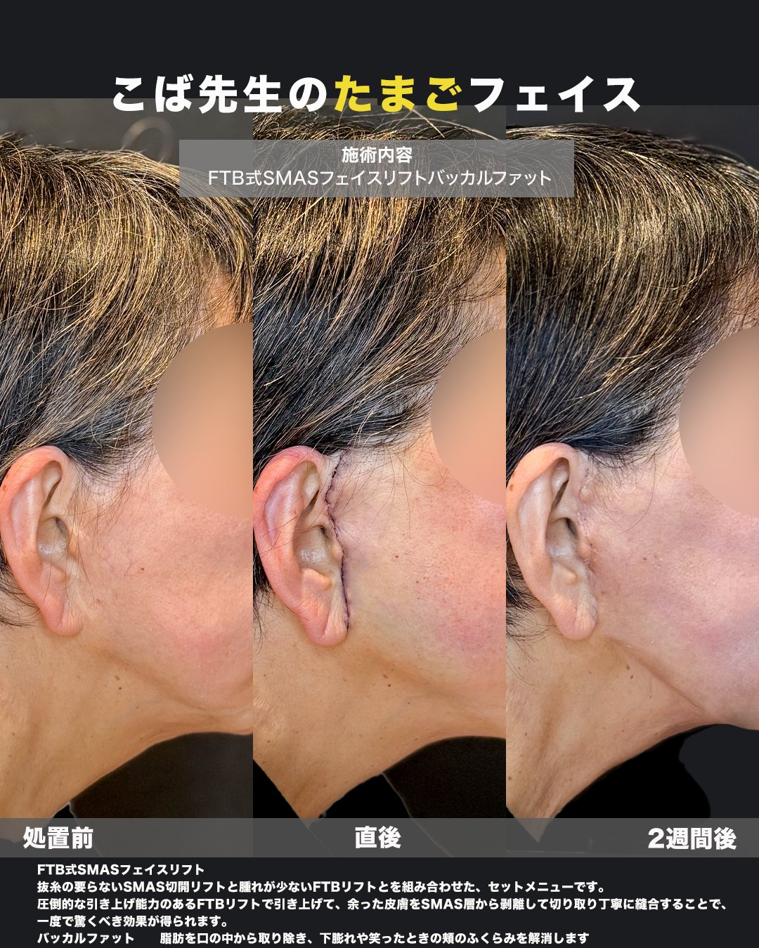 横顔の施術前・直後・2週間後の経過を並べた写真