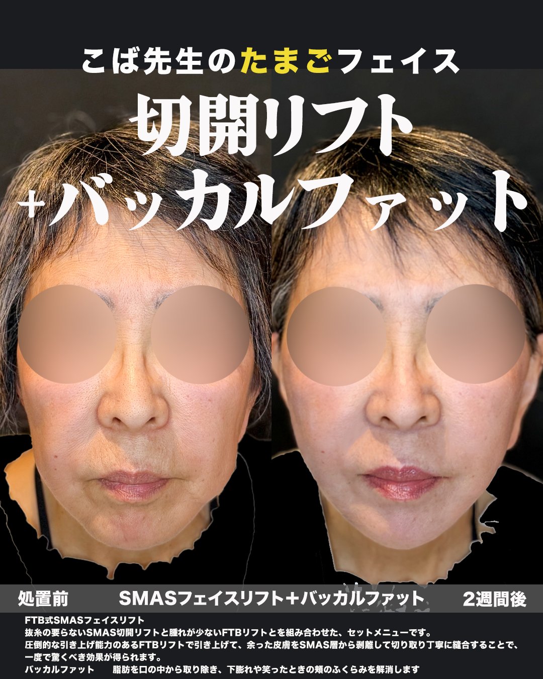 顔を正面から写した施術前と2週間後の比較写真