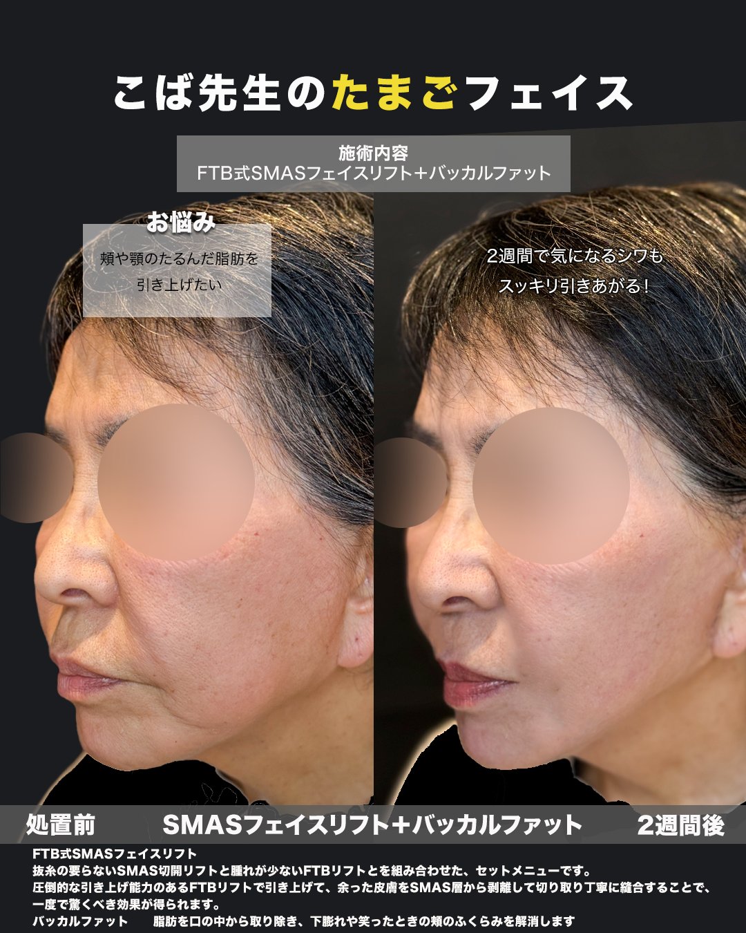 顔を斜めから写した施術前と2週間後の比較写真