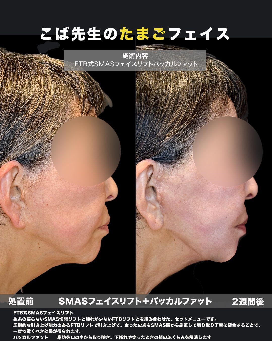 横顔を写した施術前と2週間後の比較写真