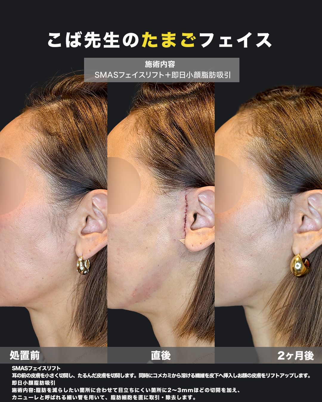 SMASフェイスリフトと即日小顔脂肪吸引の症例。処置前・直後・2ヶ月後を横から並べた比較写真（耳前の切開部を含む）。