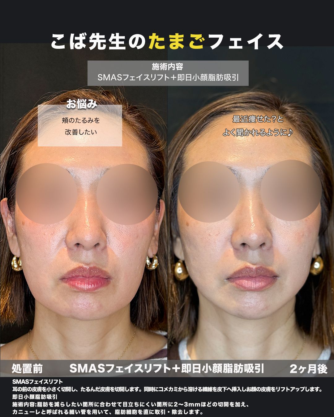 SMASフェイスリフトと即日小顔脂肪吸引の症例。頬のたるみの改善を目的とした、処置前と2ヶ月後を正面から並べた比較写真。