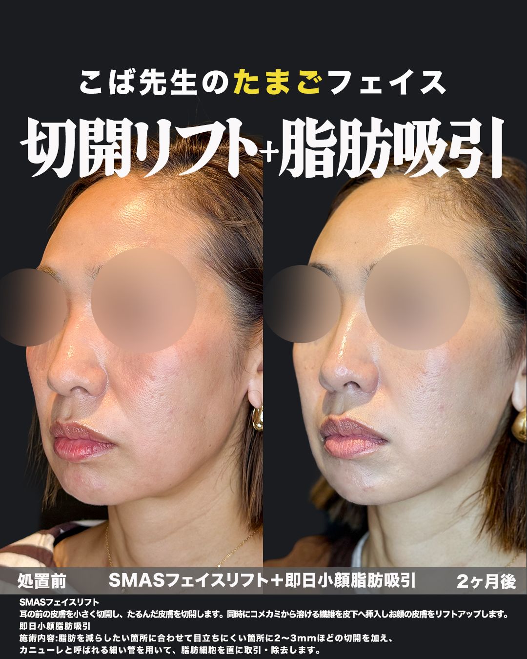 SMASフェイスリフトと即日小顔脂肪吸引の症例。処置前と2ヶ月後を斜めから並べた比較写真。