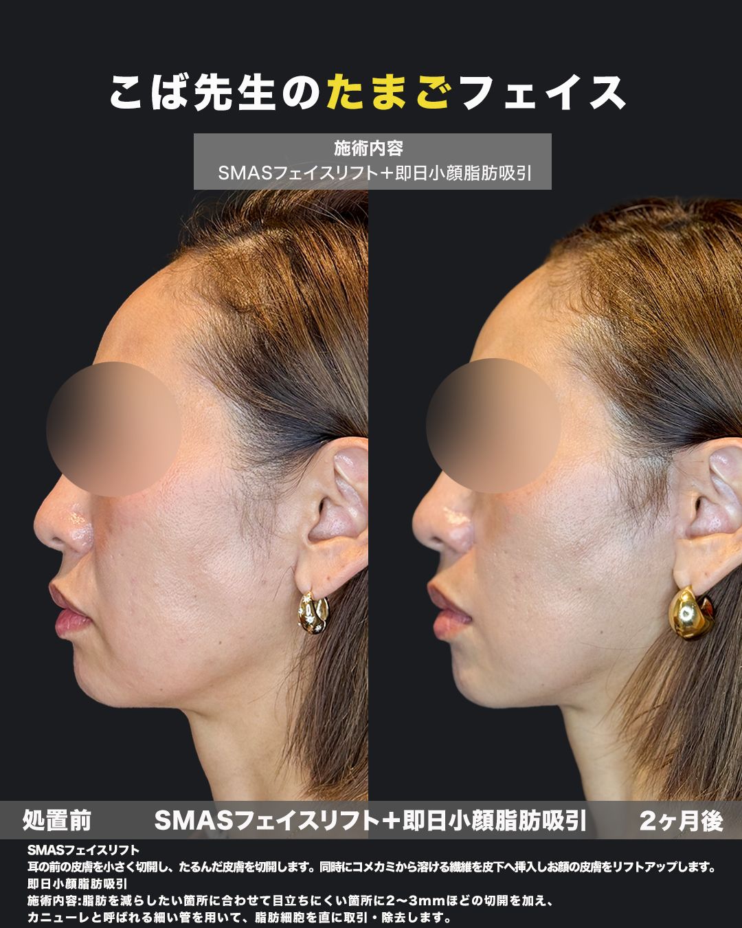 SMASフェイスリフトと即日小顔脂肪吸引の症例。処置前と2ヶ月後を横顔（側面）から並べた比較写真。