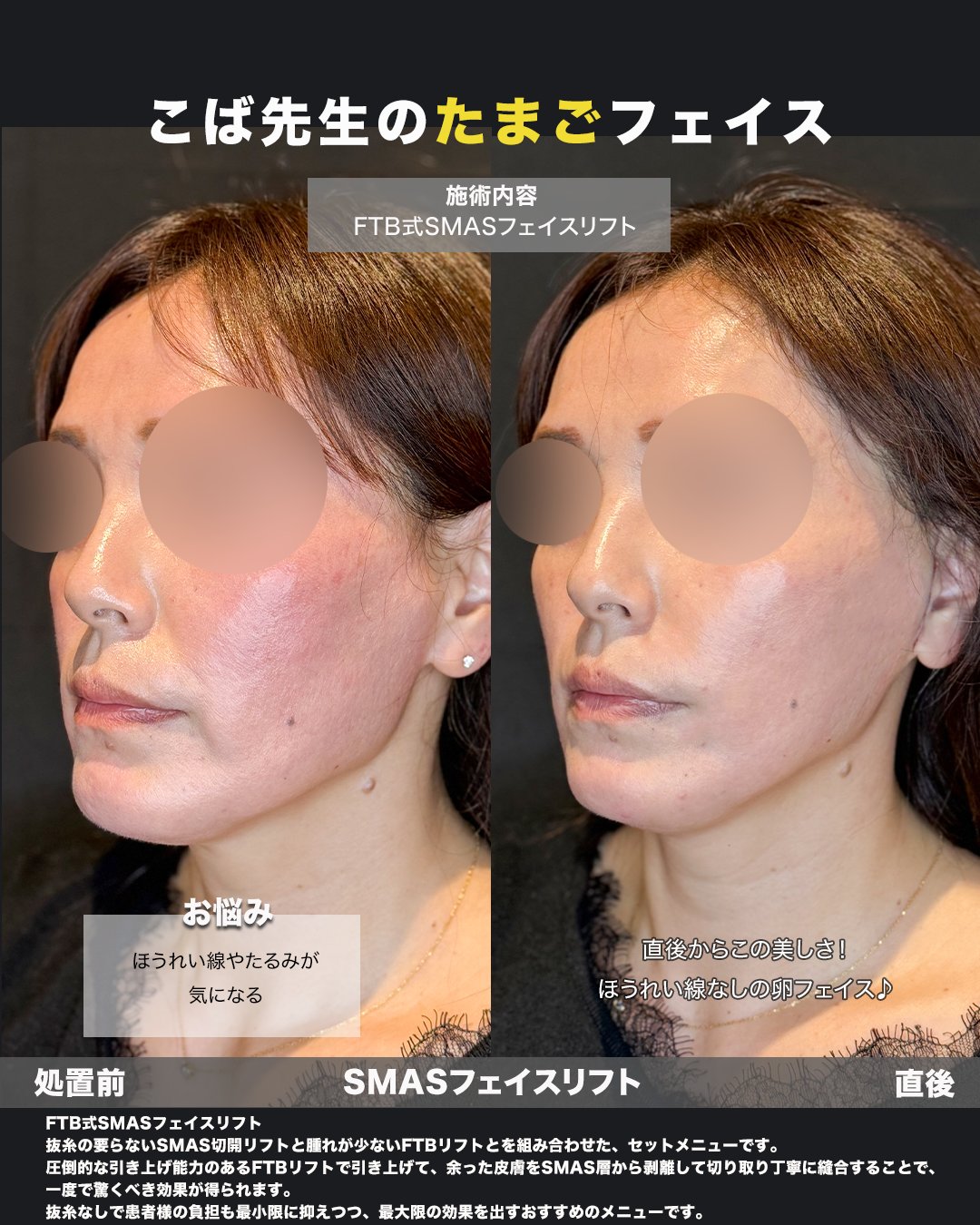 切開リフトの処置前と直後を斜めから比較した症例写真