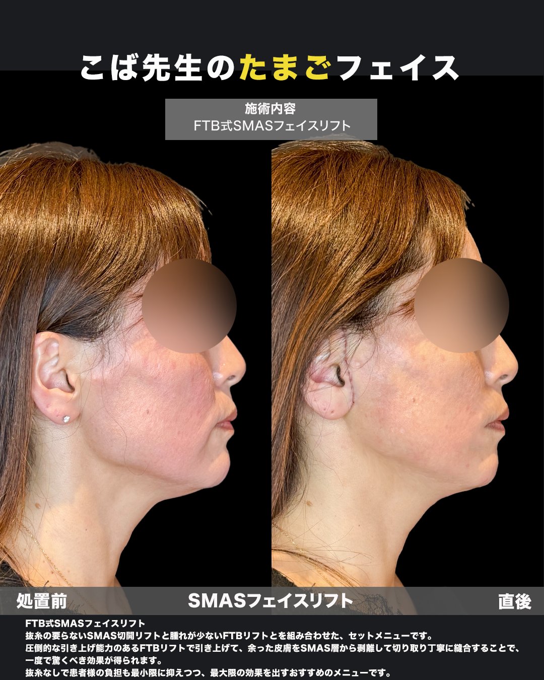 切開リフトの処置前と直後を横から比較した症例写真