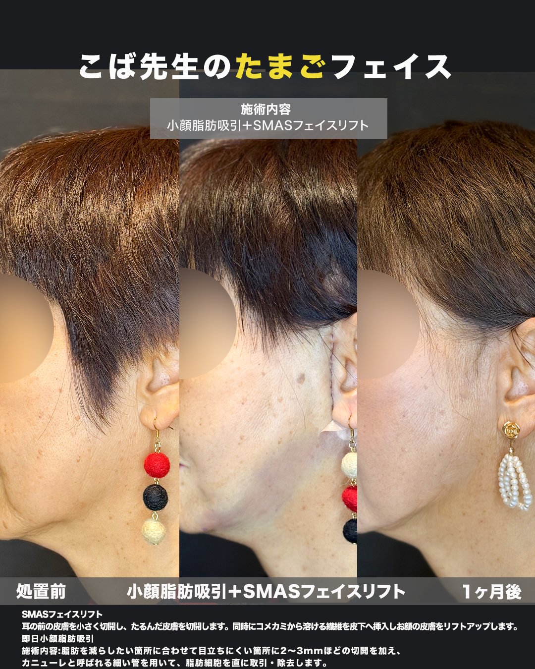 切開リフト＋頬・ジョールファット脂肪吸引の術前術後比較写真