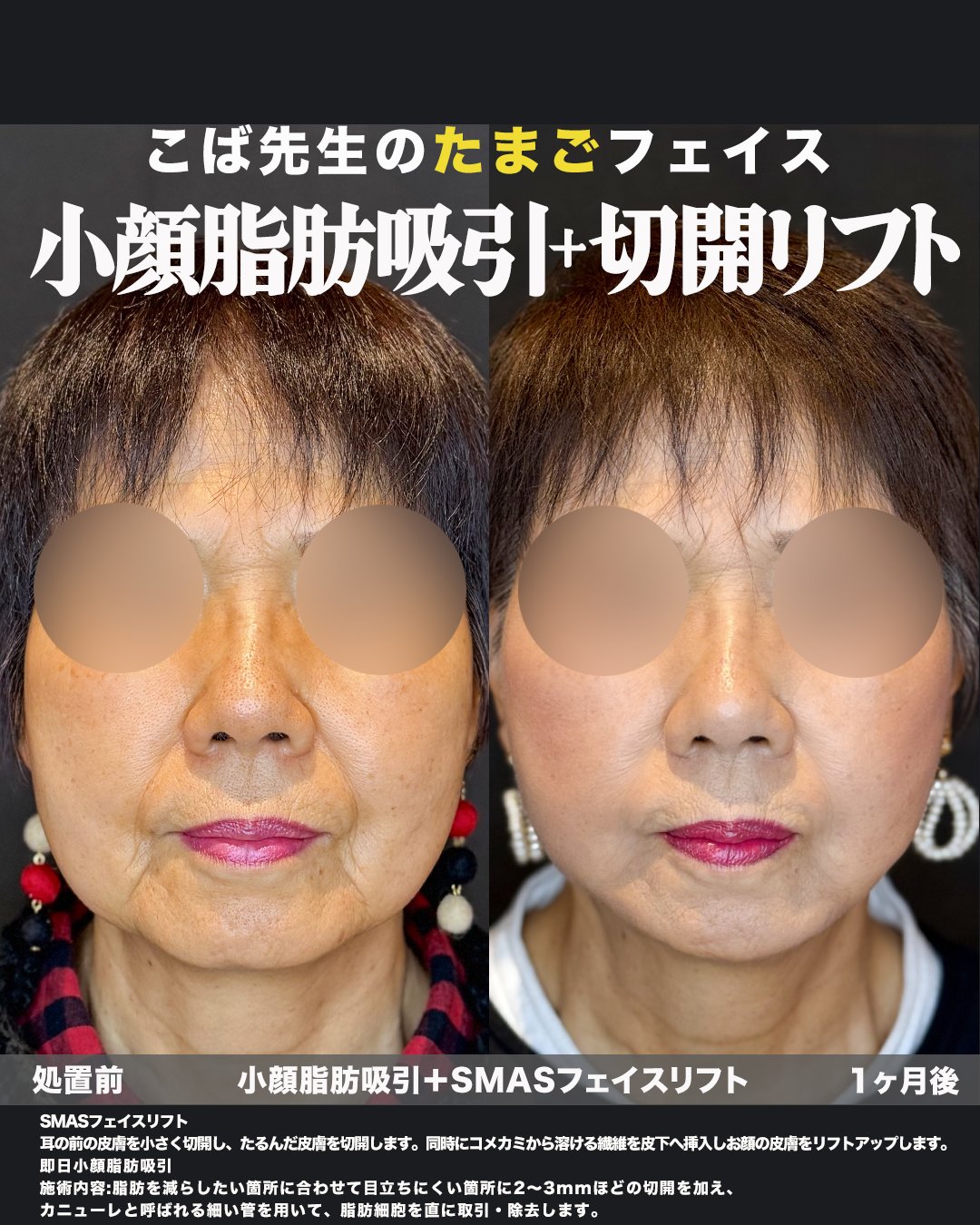 切開リフト＋頬・ジョールファット脂肪吸引の症例写真（正面・術前術後）