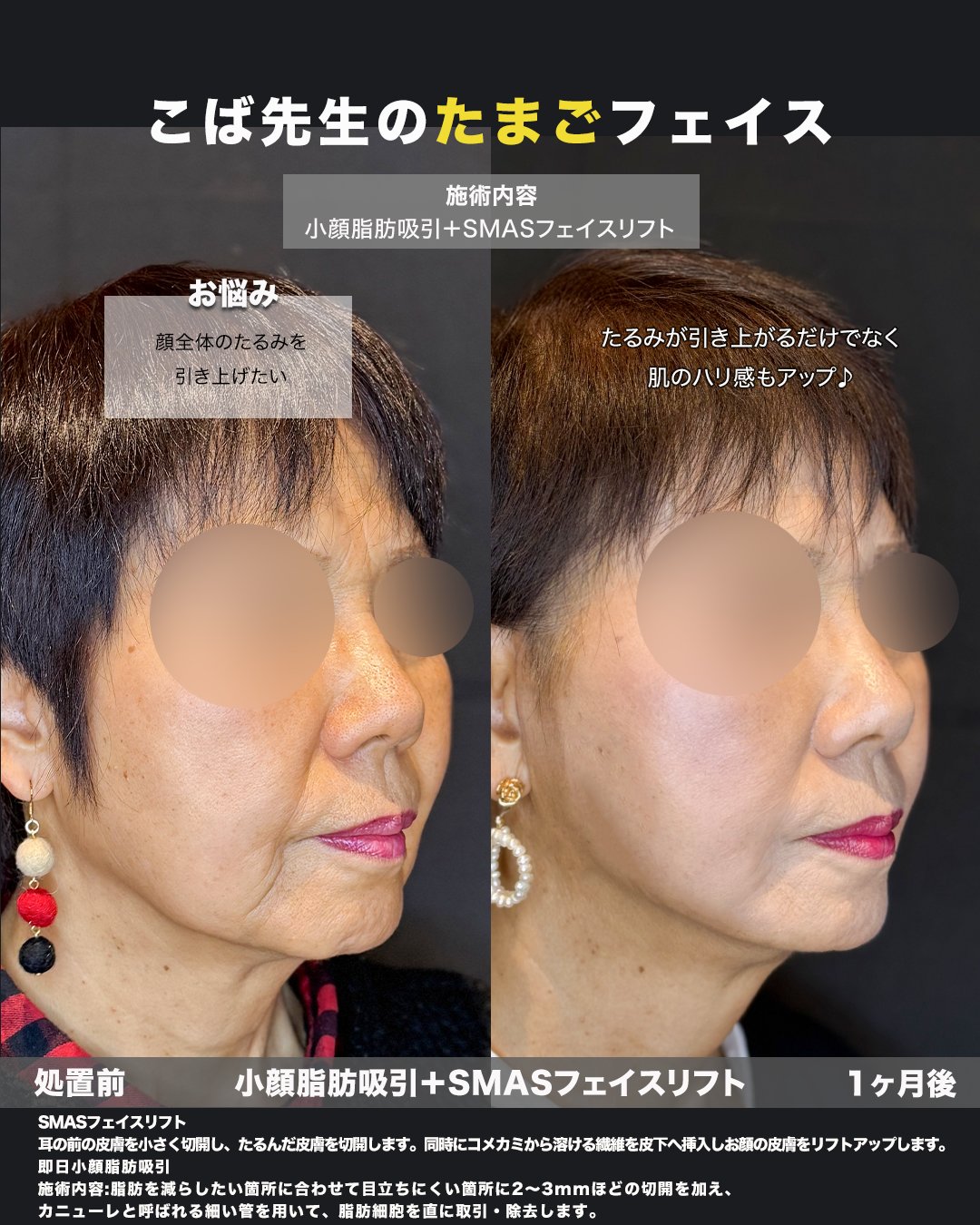 切開リフト＋頬・ジョールファット脂肪吸引の症例写真（斜め・術前術後）