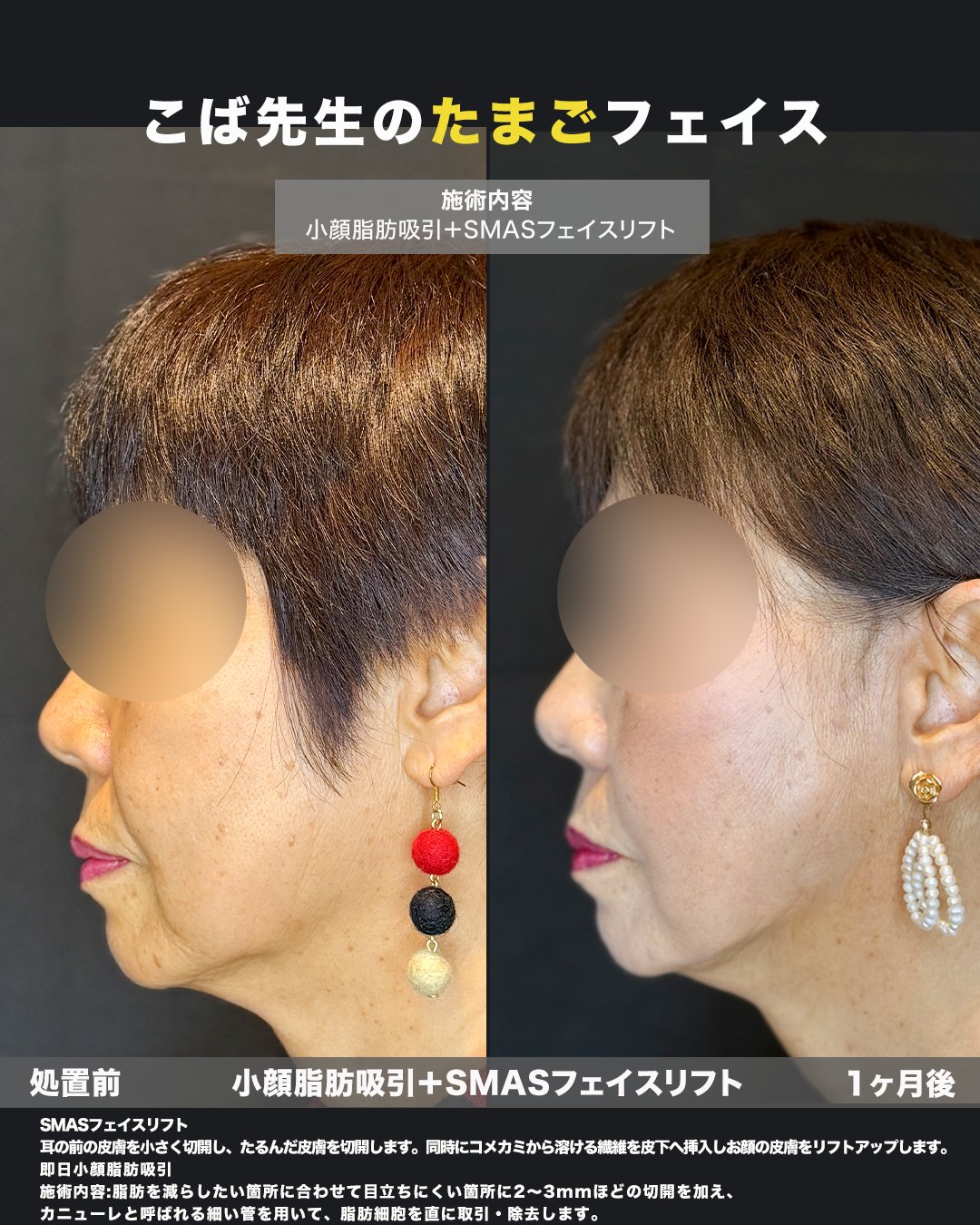 切開リフト＋頬・ジョールファット脂肪吸引の症例写真（横向き・術前術後）