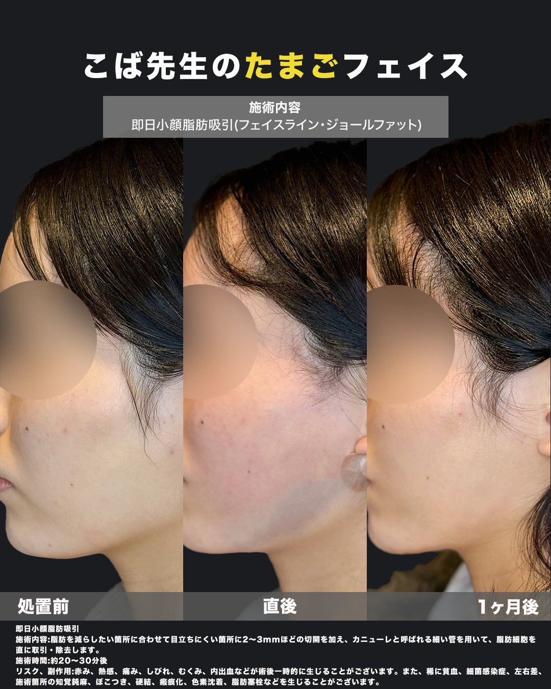 小顔脂肪吸引の施術前・直後・1ヶ月後を並べた横顔の写真