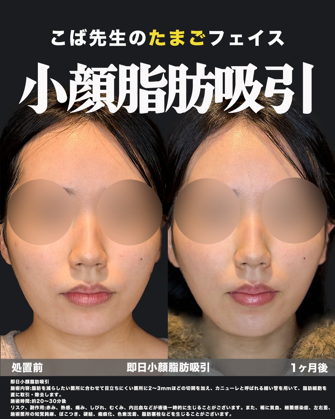 小顔脂肪吸引の施術前と1ヶ月後を比べた正面の写真