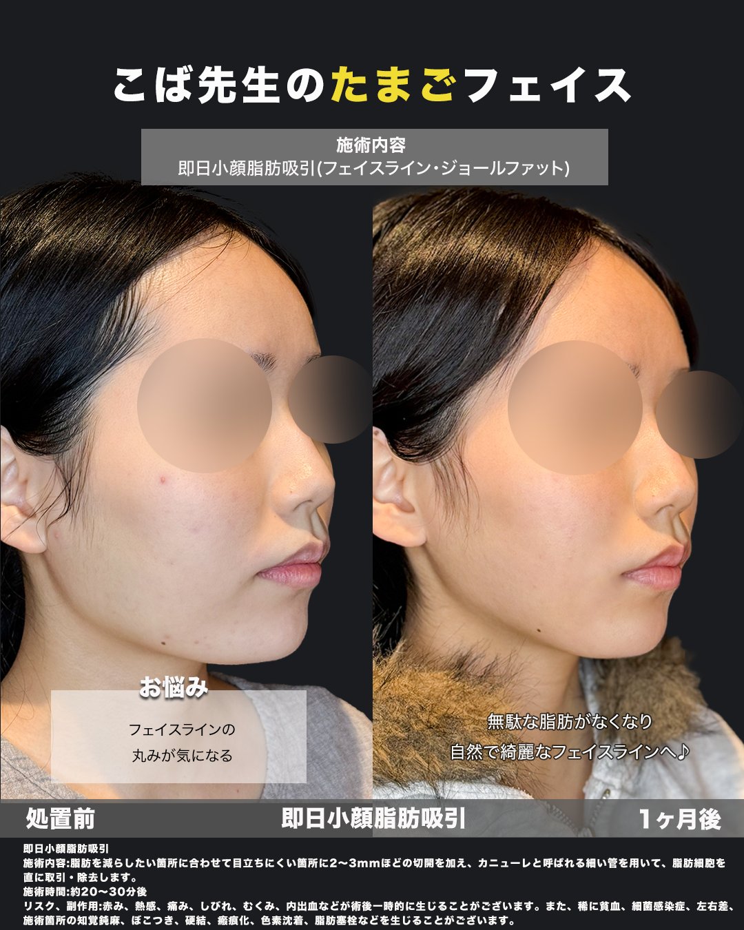 小顔脂肪吸引の施術前と1ヶ月後を比べた斜めからの写真