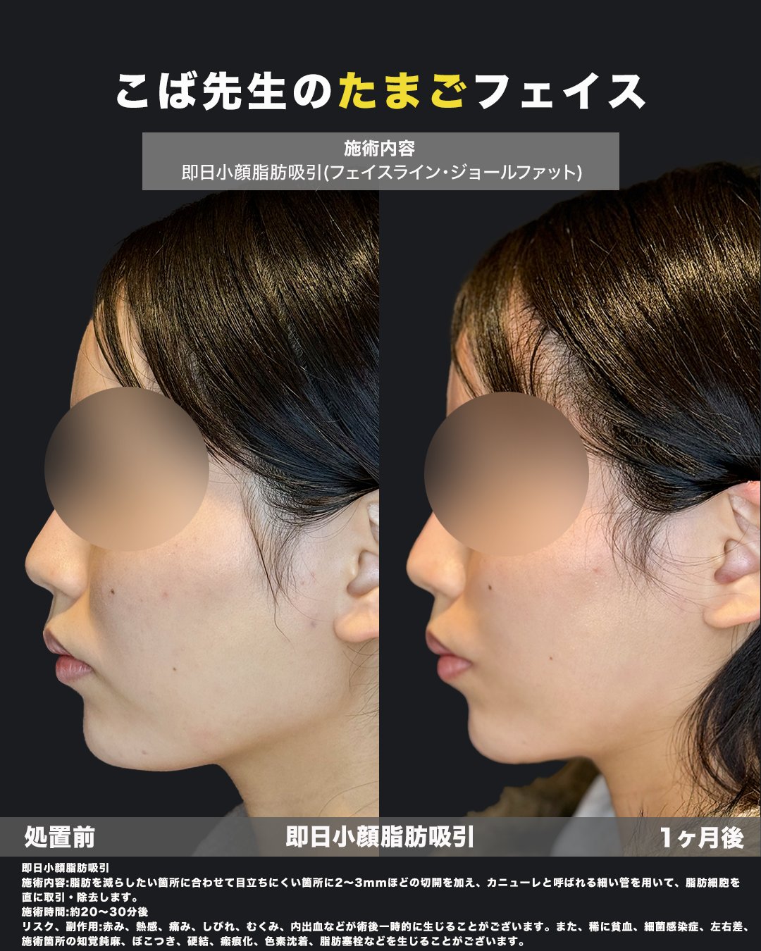 小顔脂肪吸引の施術前と1ヶ月後を比べた横顔の写真