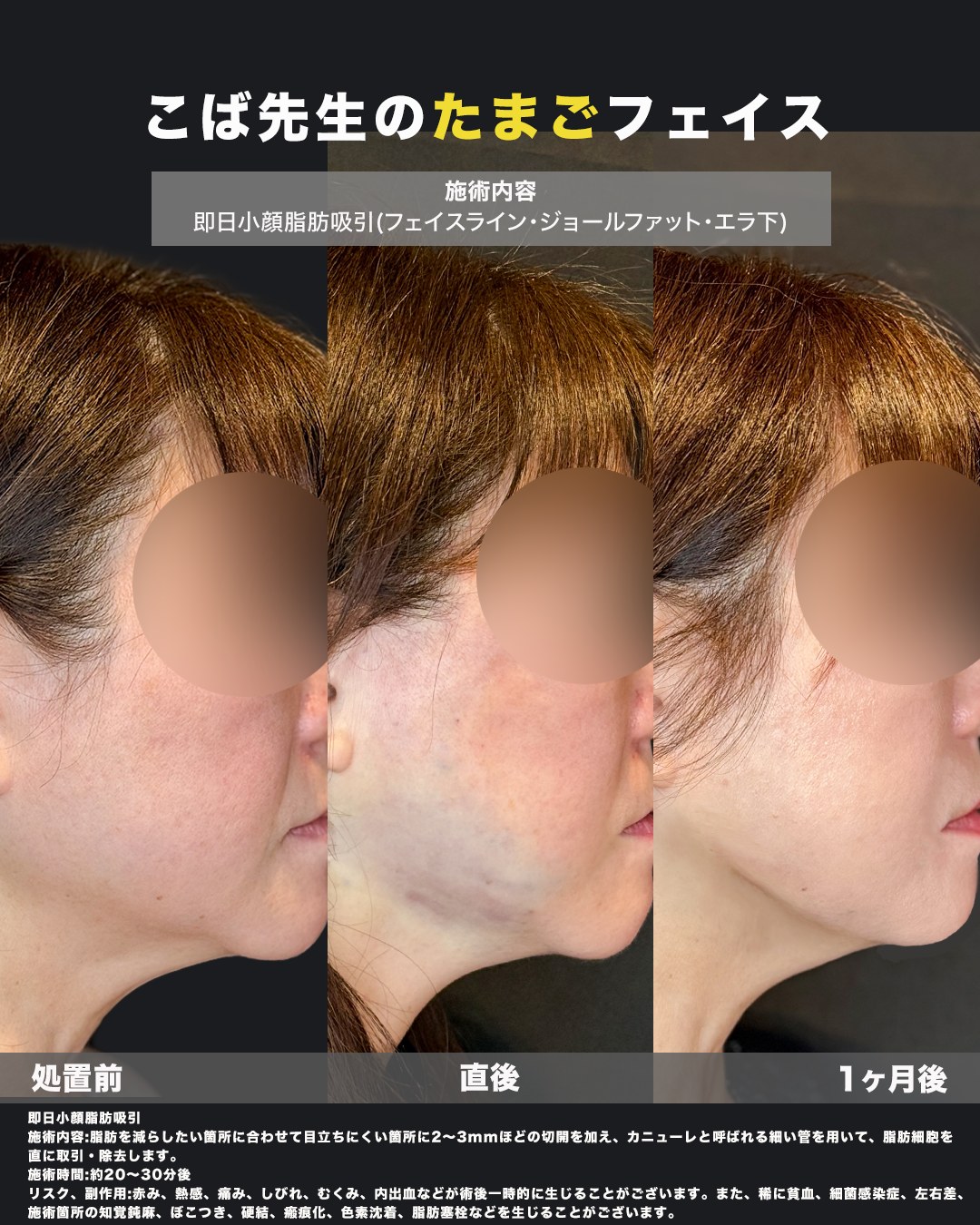 小顔脂肪吸引を受けた方の処置前・直後・1ヶ月後を並べた横顔の写真