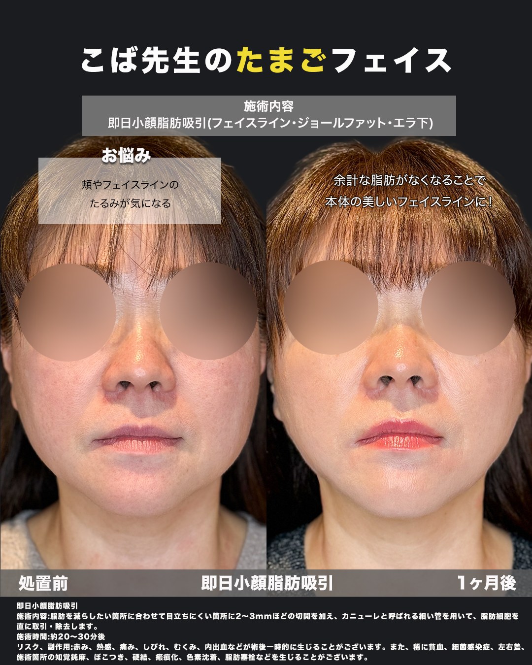 小顔脂肪吸引を受けた方の処置前と1ヶ月後の正面写真