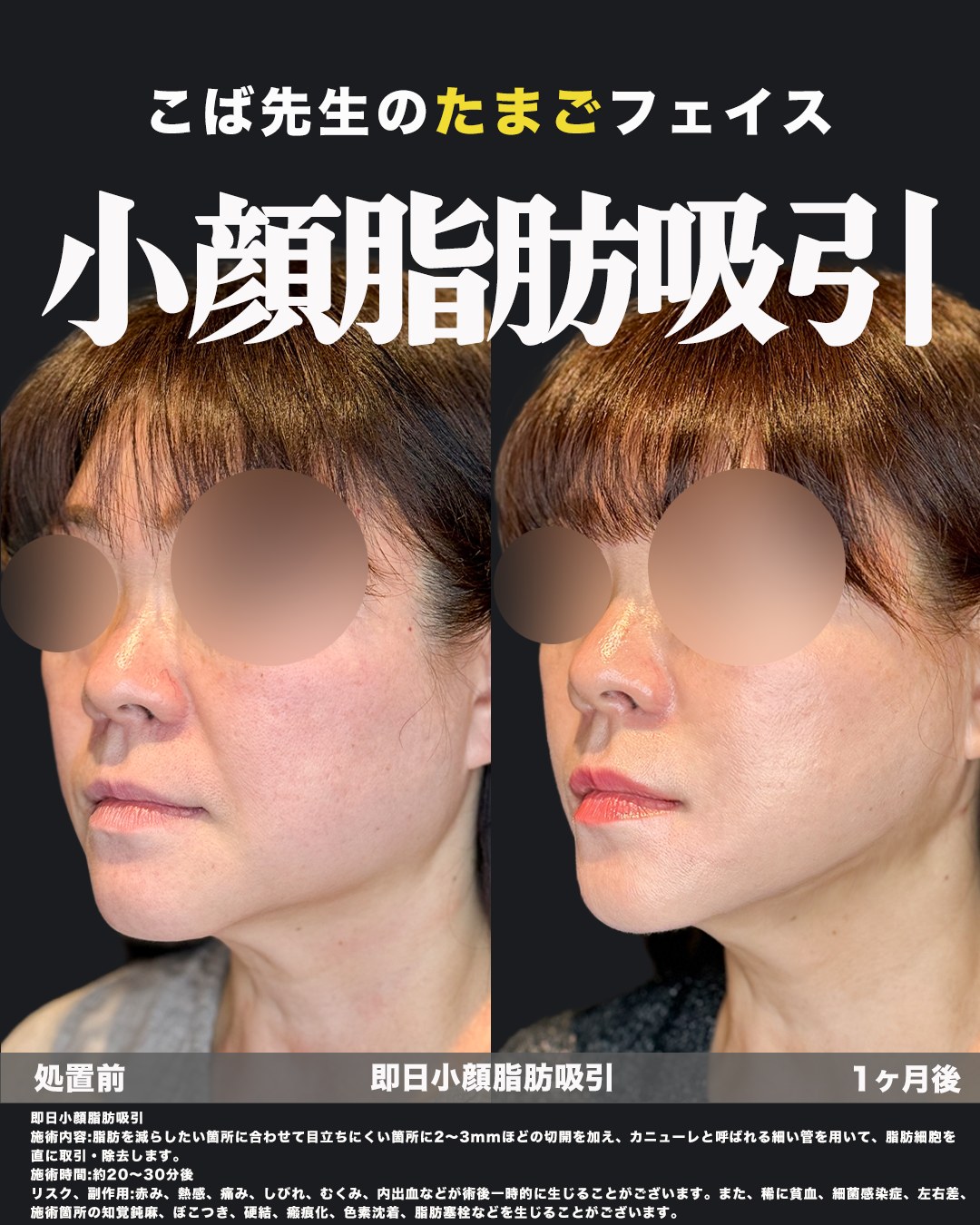 小顔脂肪吸引を受けた方の処置前と1ヶ月後の斜めからの写真