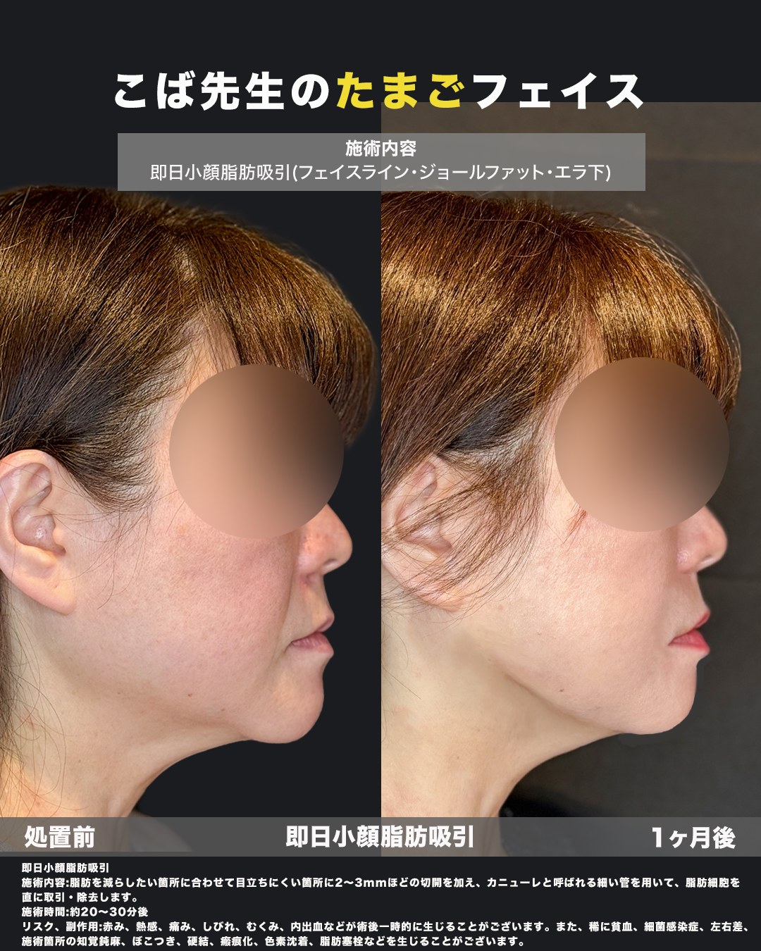 小顔脂肪吸引を受けた方の処置前と1ヶ月後の横顔の写真