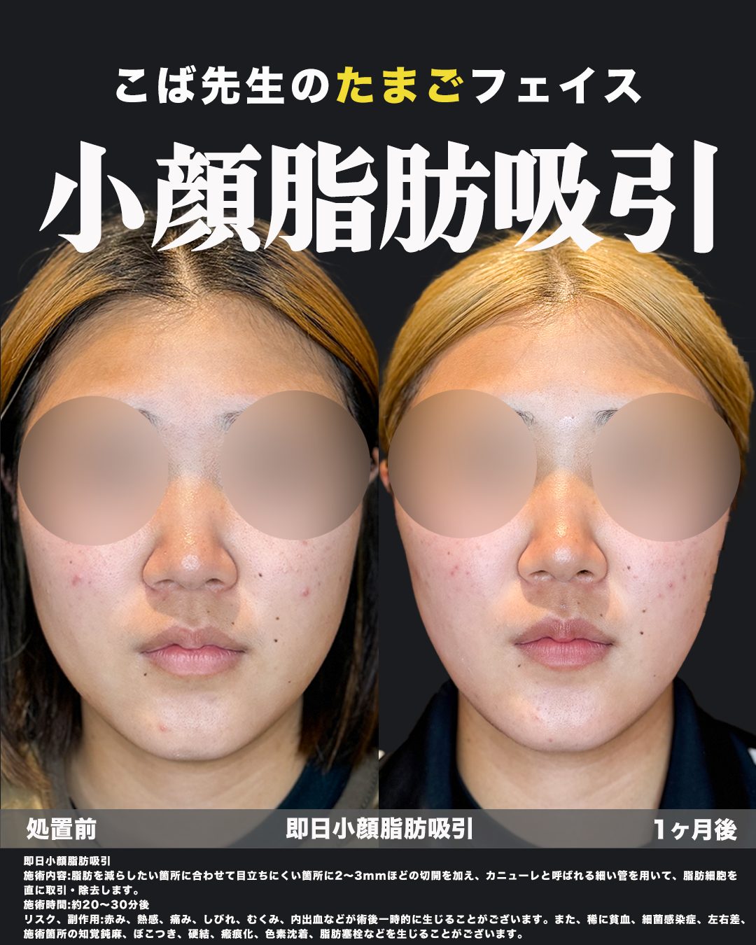 小顔脂肪吸引の症例（フェイスライン・ジョールファット・エラ・あご下）正面