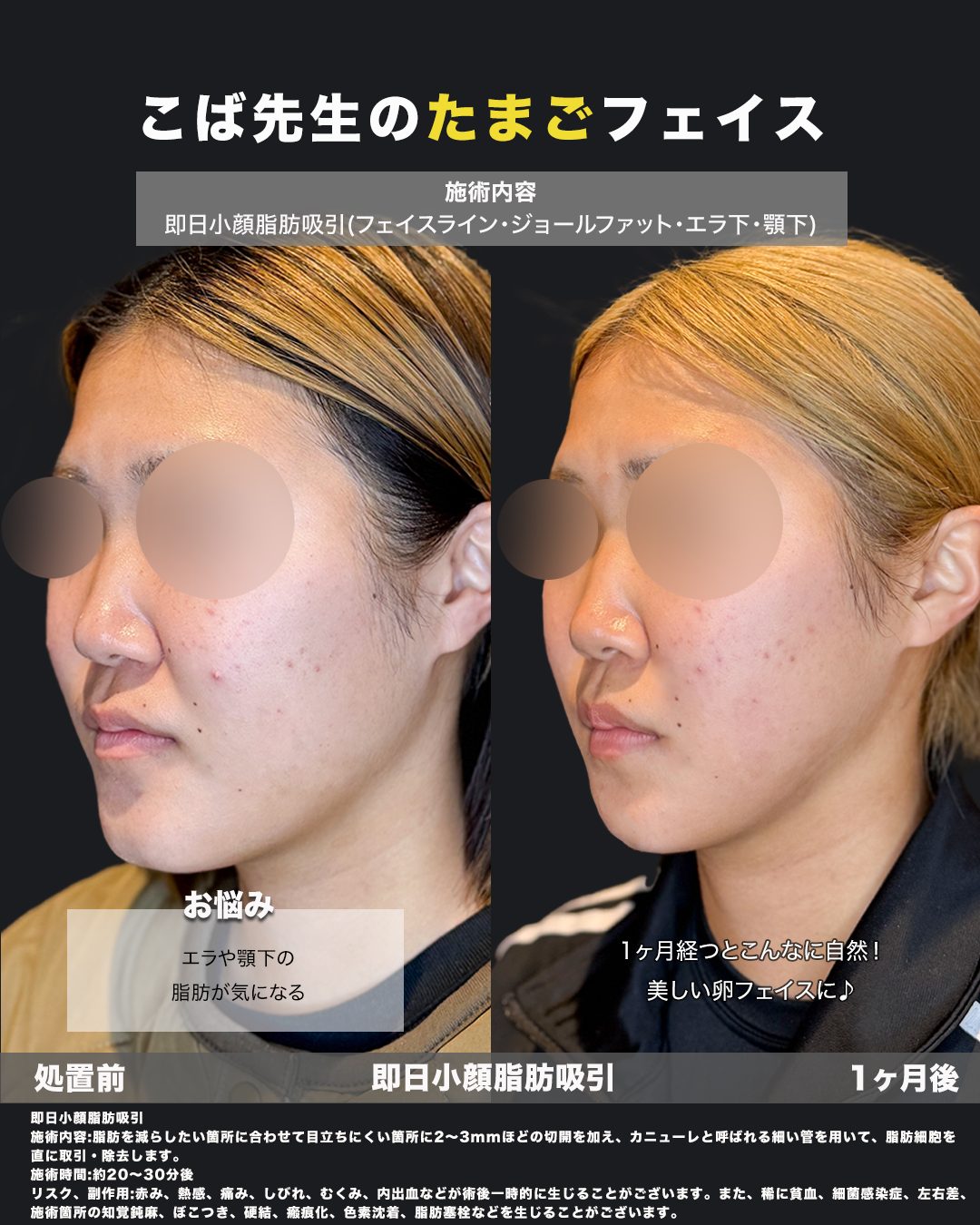 小顔脂肪吸引の症例（フェイスライン・ジョールファット・エラ・あご下）斜め