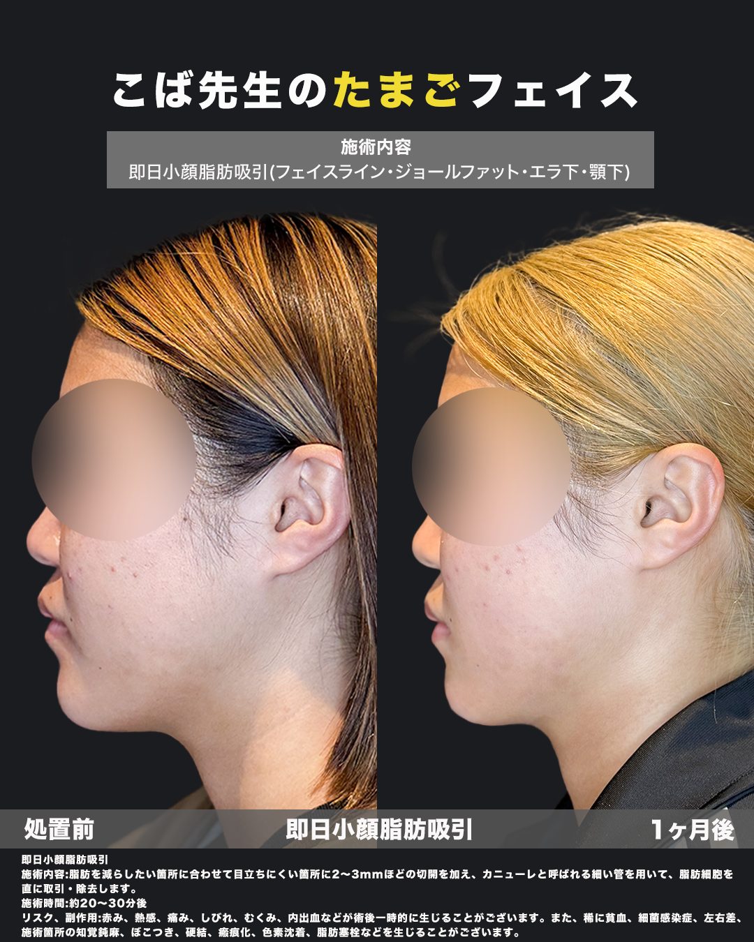 小顔脂肪吸引の症例（フェイスライン・ジョールファット・エラ・あご下）横