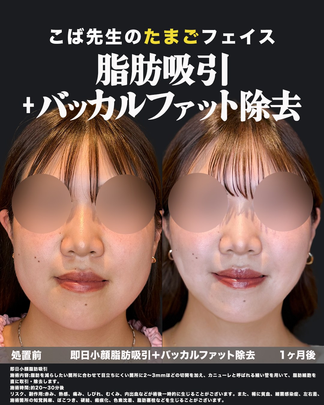 小顔脂肪吸引とバッカルファット除去の症例（正面）