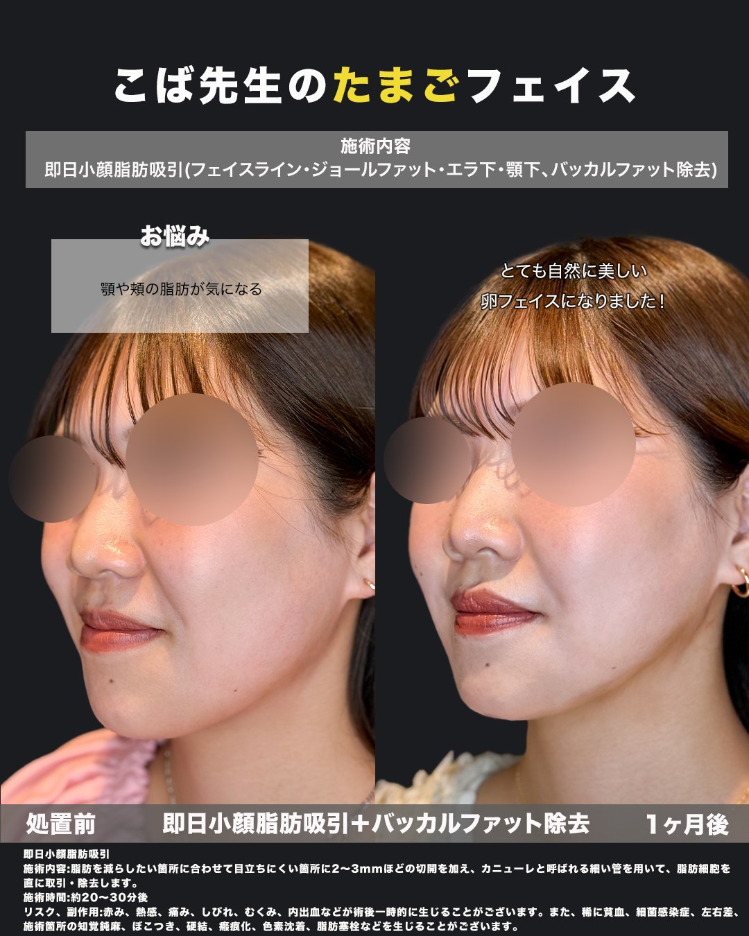 小顔脂肪吸引とバッカルファット除去の症例（斜め）