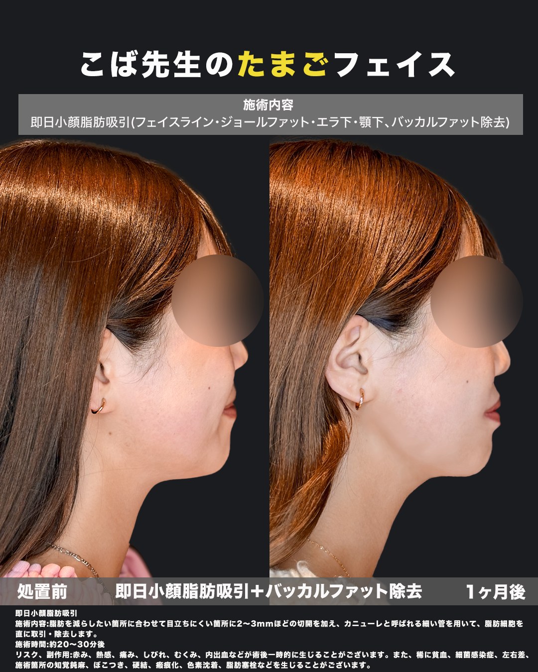小顔脂肪吸引とバッカルファット除去の症例（横）