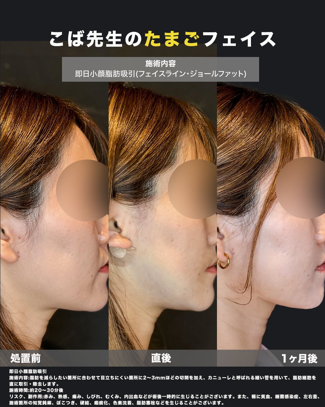 脂肪吸引施術の症例写真（施術前後比較）