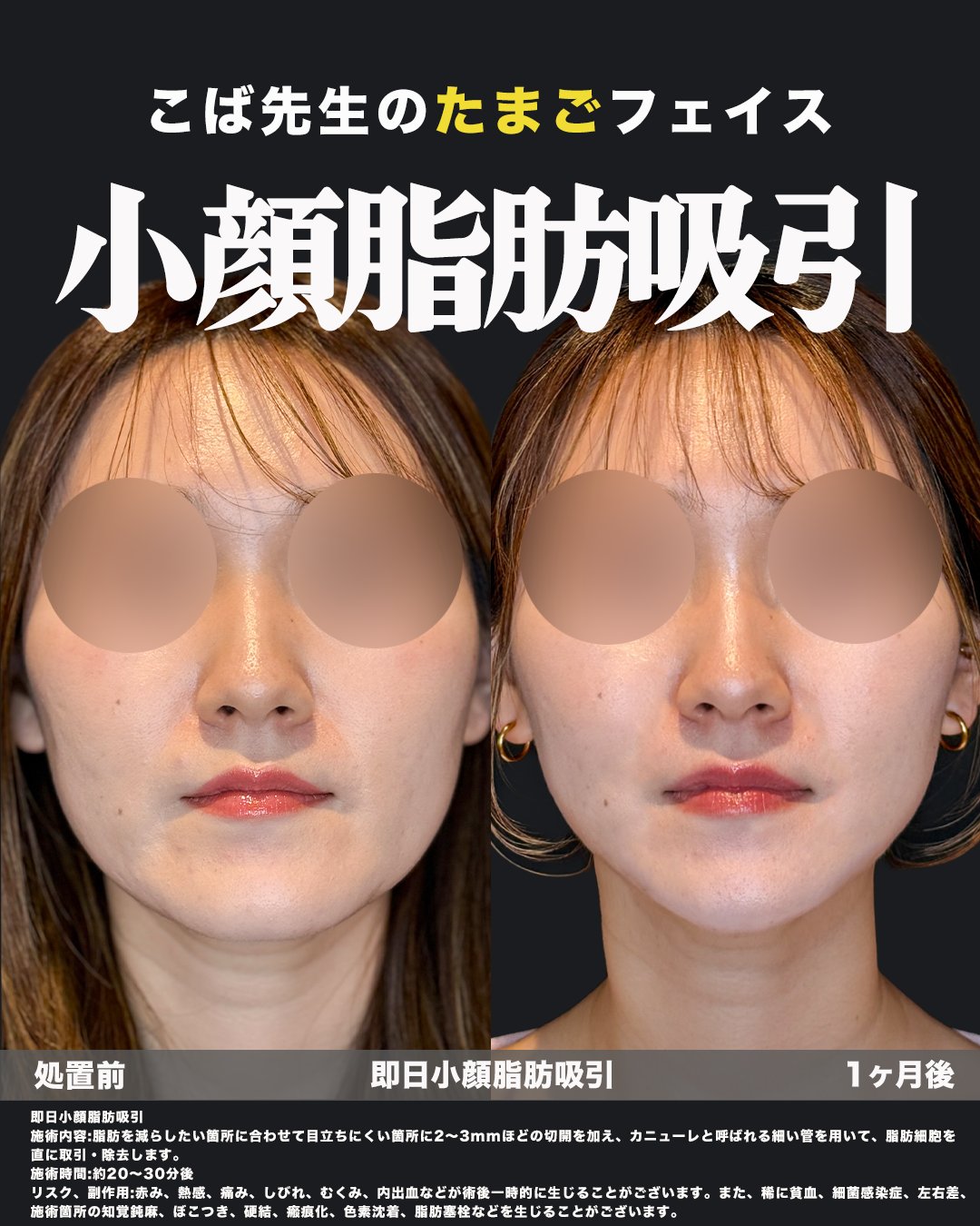 脂肪吸引施術の症例写真（正面）