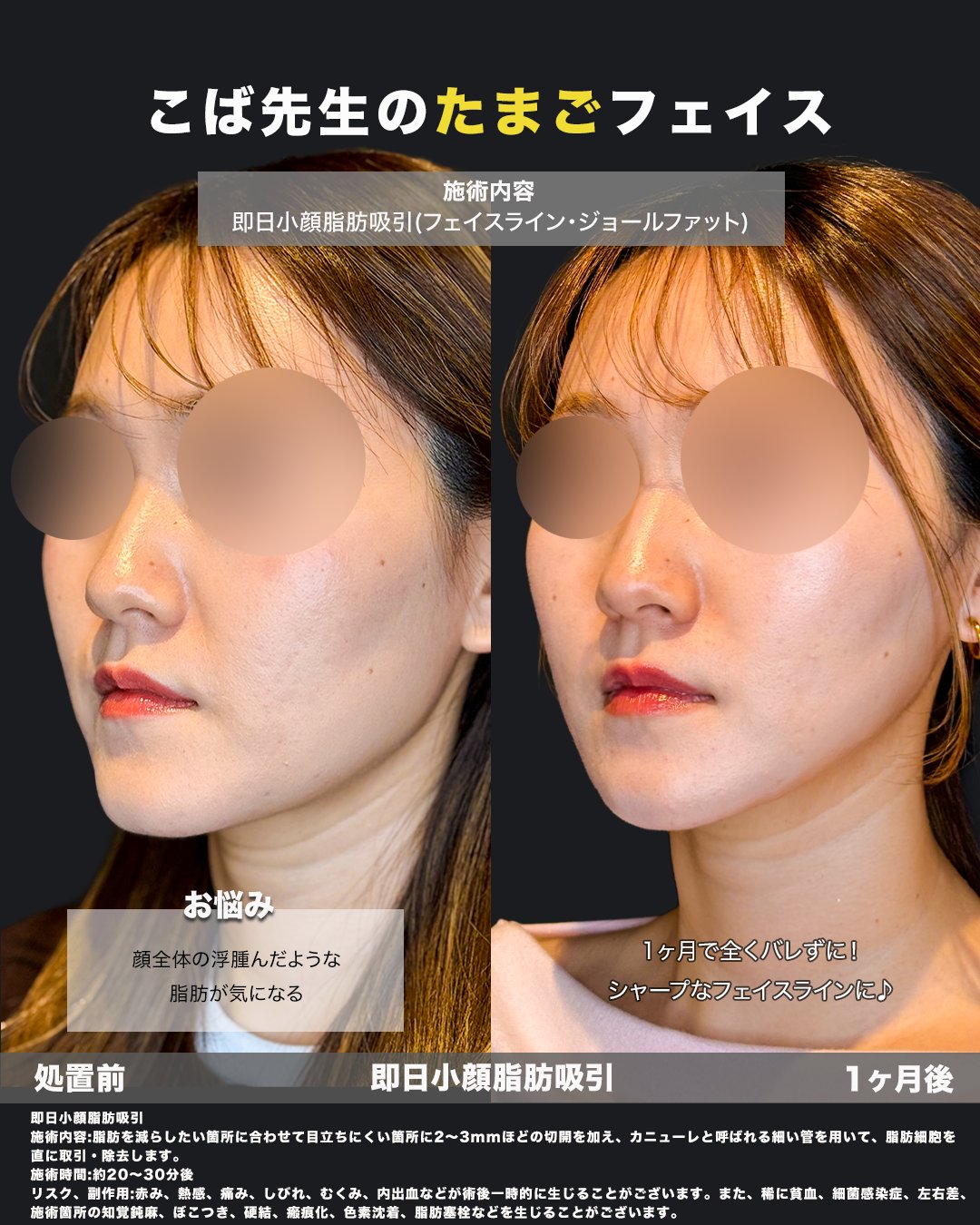脂肪吸引施術の症例写真（斜め）
