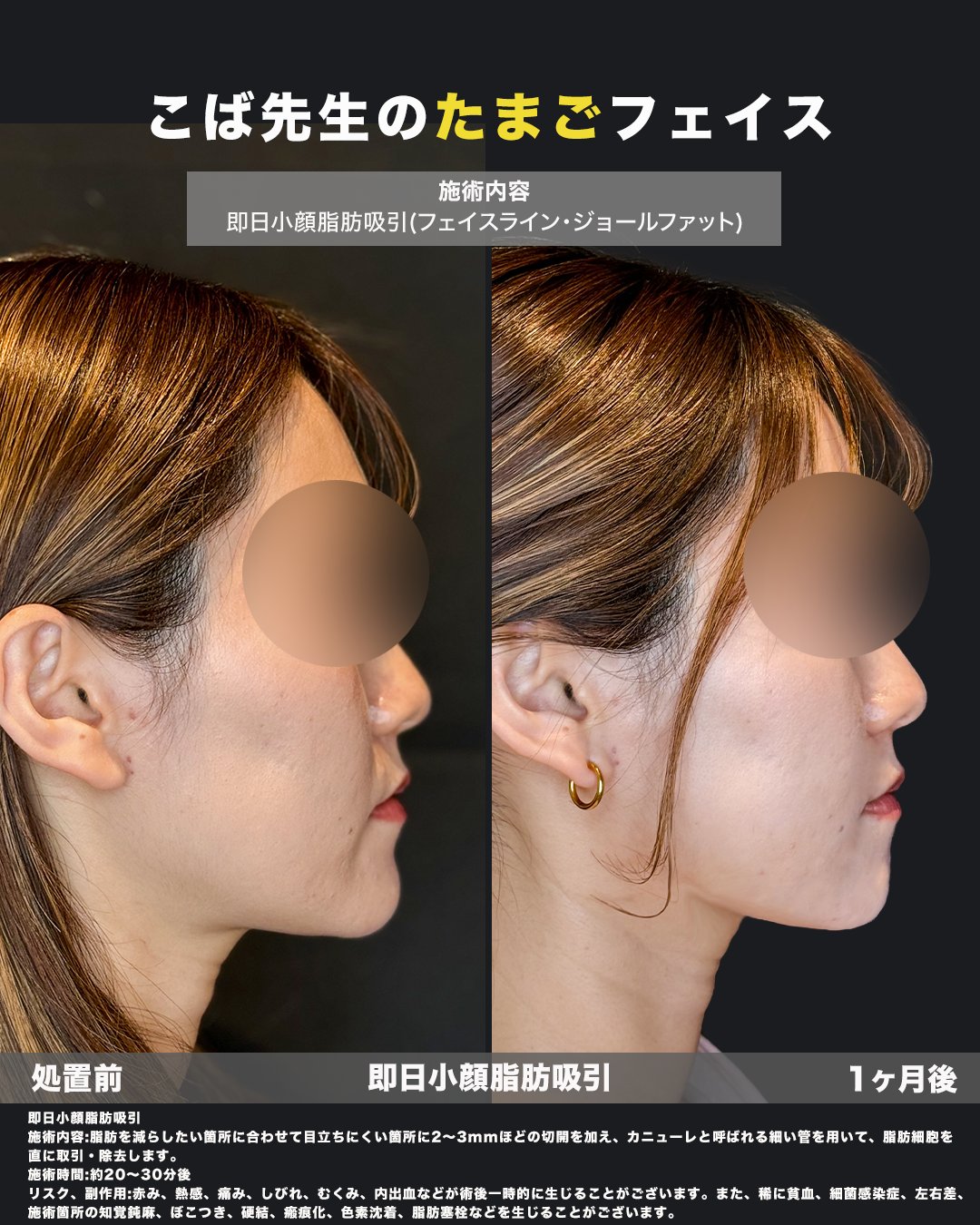 脂肪吸引施術の症例写真（横）