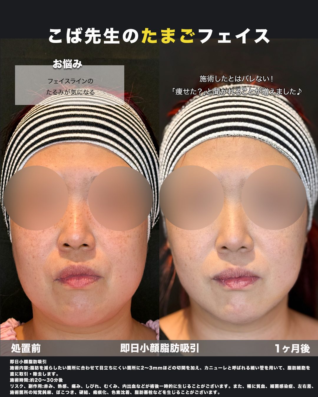 小顔脂肪吸引（フェイスライン・ジョールファット・エラ下・顎下）の症例。処置前と術後を正面から並べた比較写真。