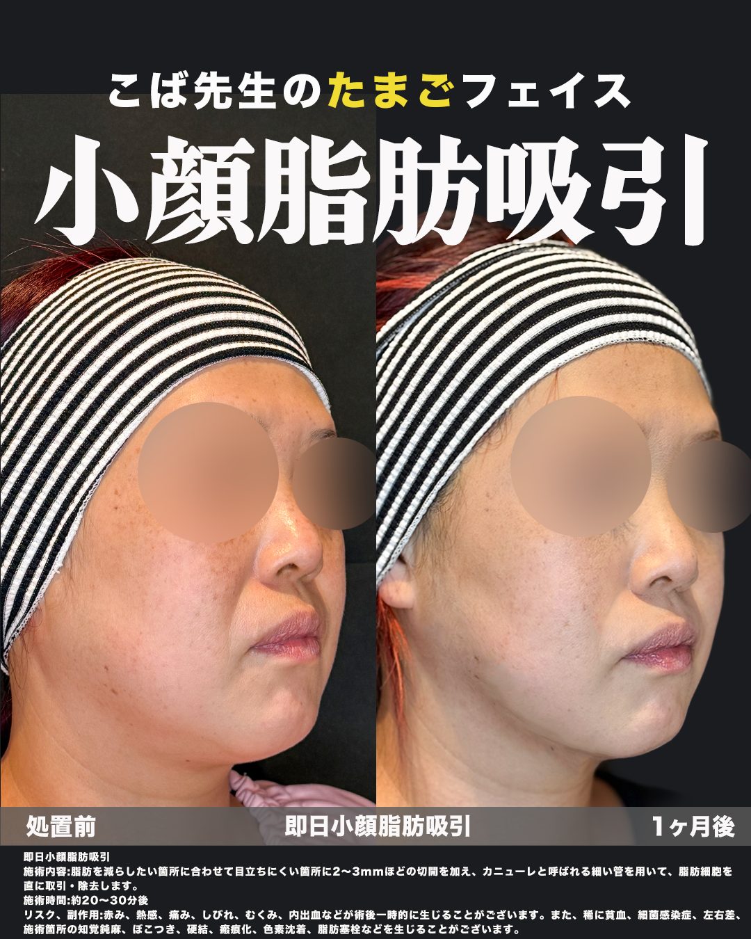 小顔脂肪吸引（フェイスライン・ジョールファット・エラ下・顎下）の症例。処置前と術後を斜めから並べた比較写真。