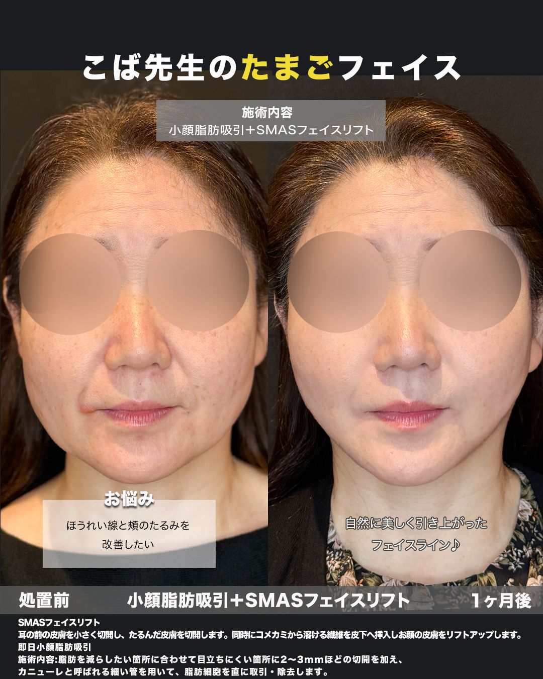 SMASフェイスリフト＋小顔脂肪吸引の症例。処置前と3ヶ月後を正面から並べた比較写真。