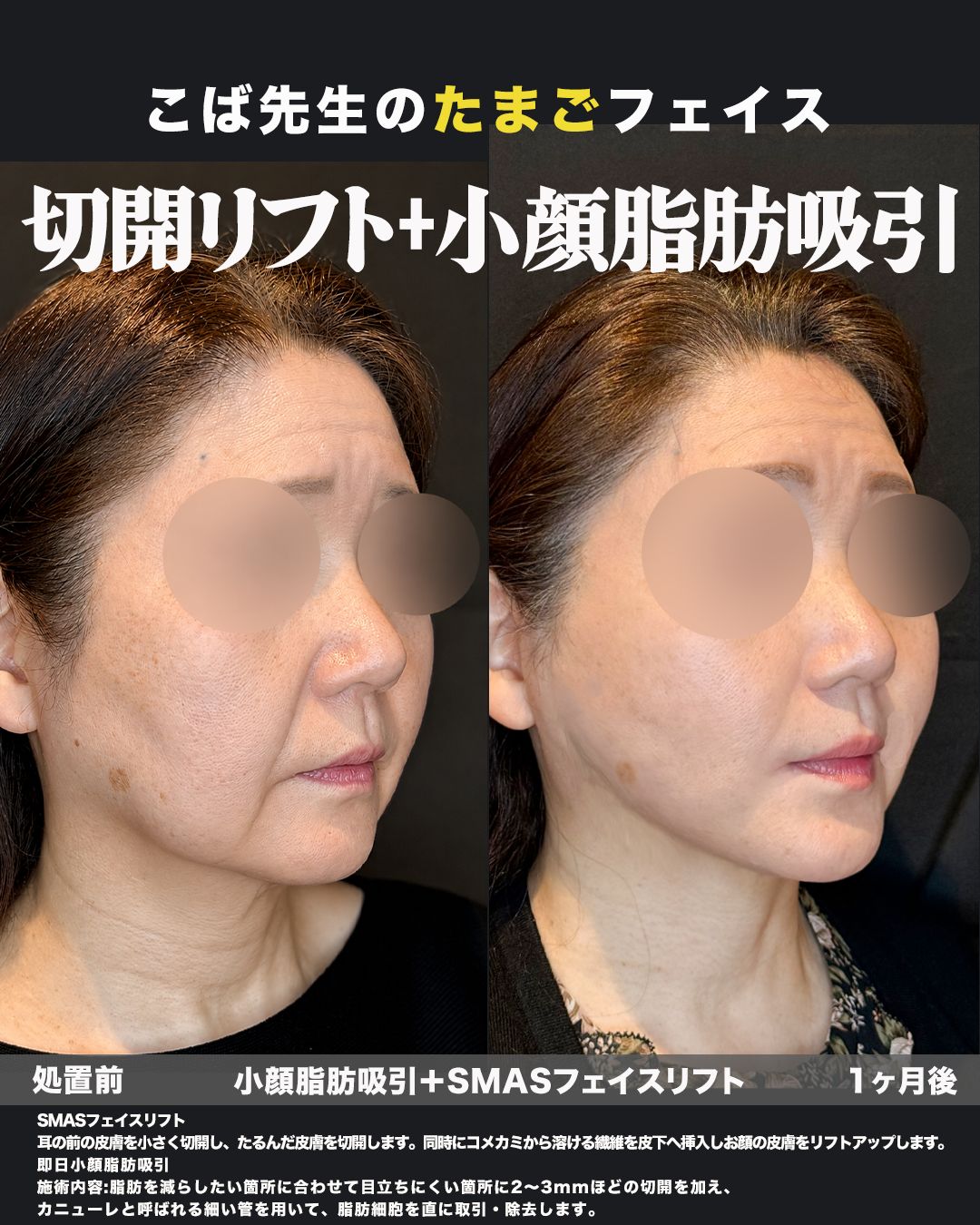 SMASフェイスリフト＋小顔脂肪吸引の症例。処置前と3ヶ月後を斜めから並べた比較写真。