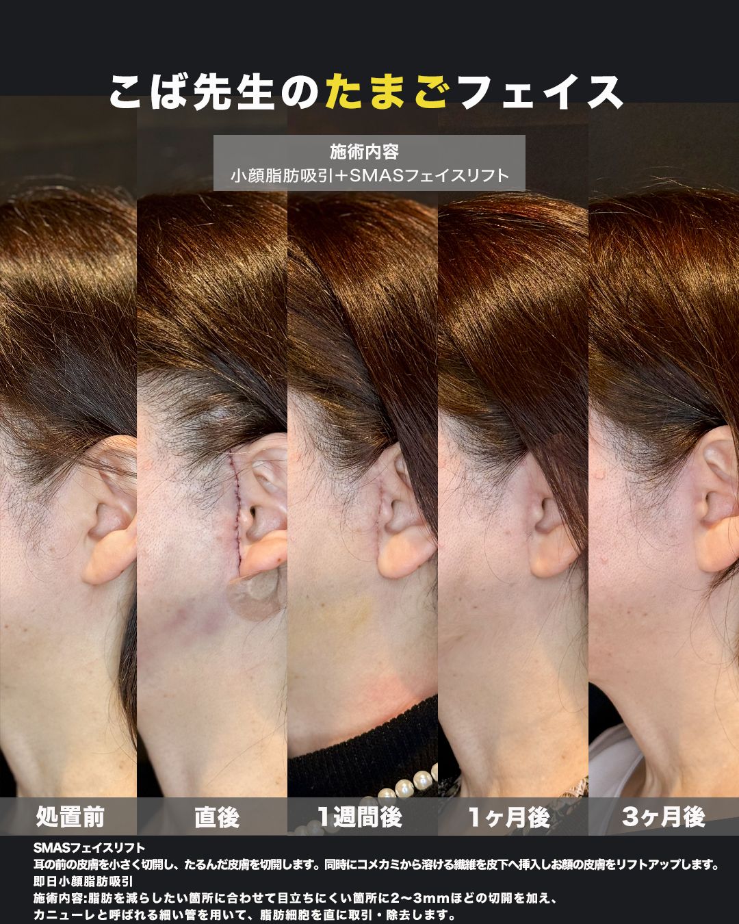 SMASフェイスリフト＋小顔脂肪吸引の症例。処置前と3ヶ月後を正面から並べた比較写真。