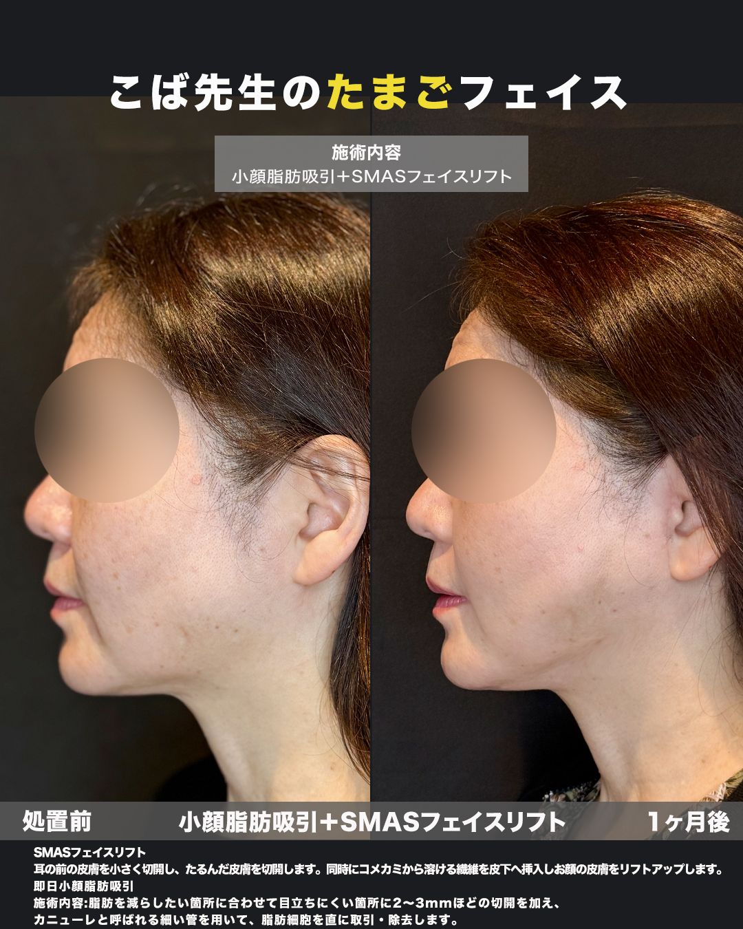 SMASフェイスリフト＋小顔脂肪吸引の症例。処置前と3ヶ月後を横（側面）から並べた比較写真。