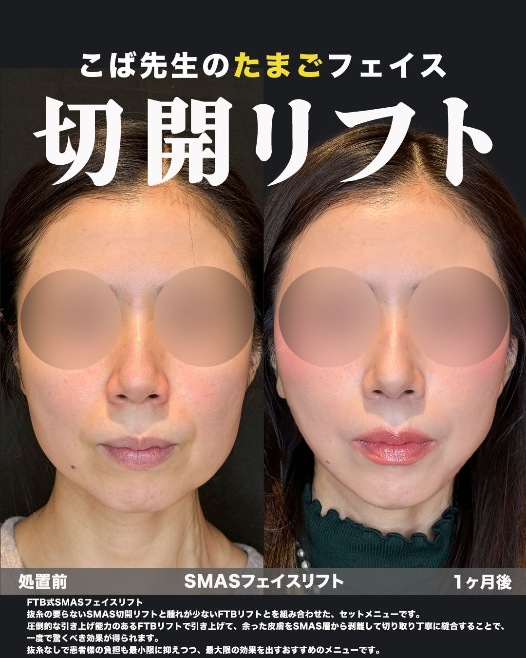 SMASフェイスリフトの症例。処置前と術後を正面から並べた比較写真。