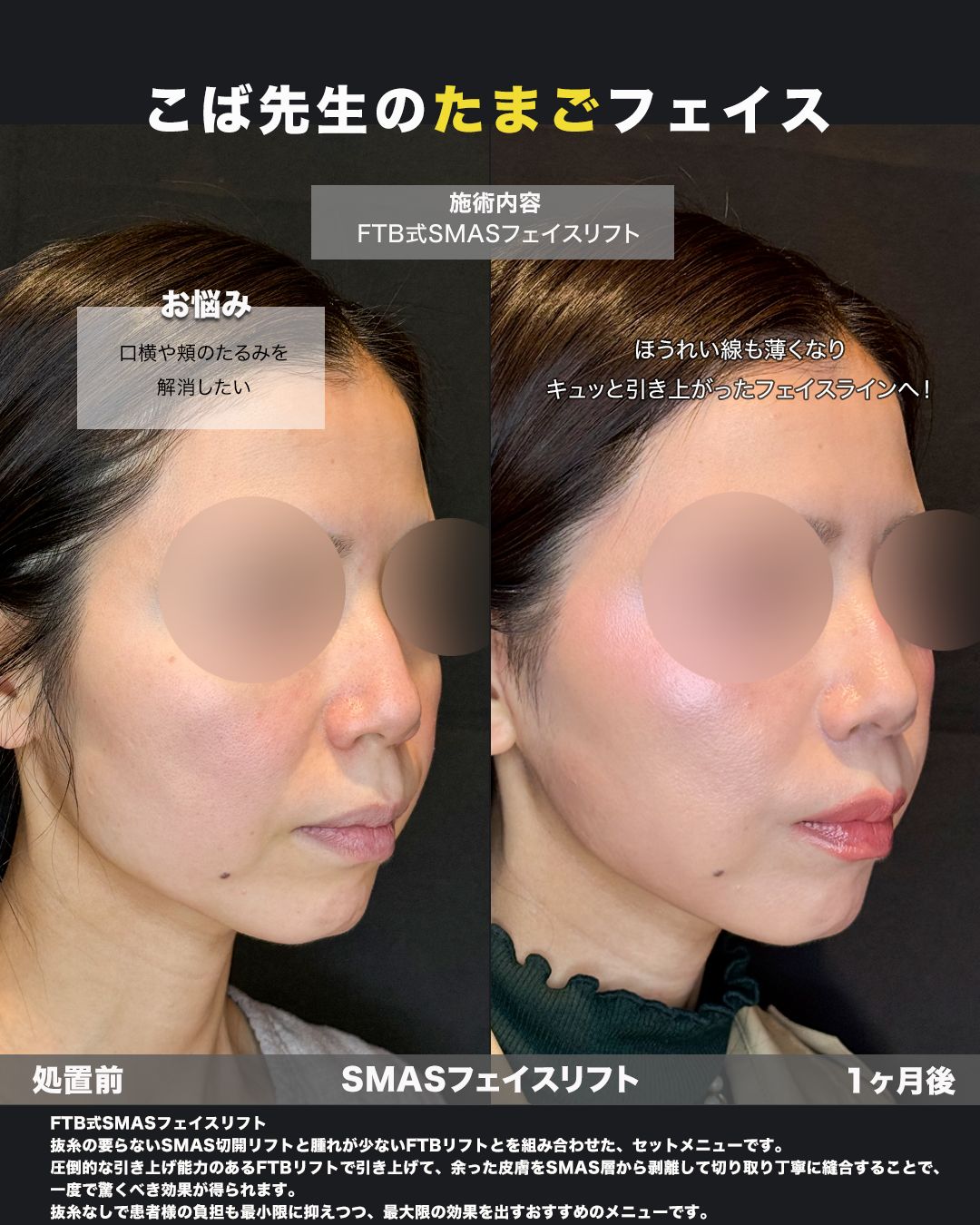 SMASフェイスリフトの症例。処置前と術後を斜めから並べた比較写真。