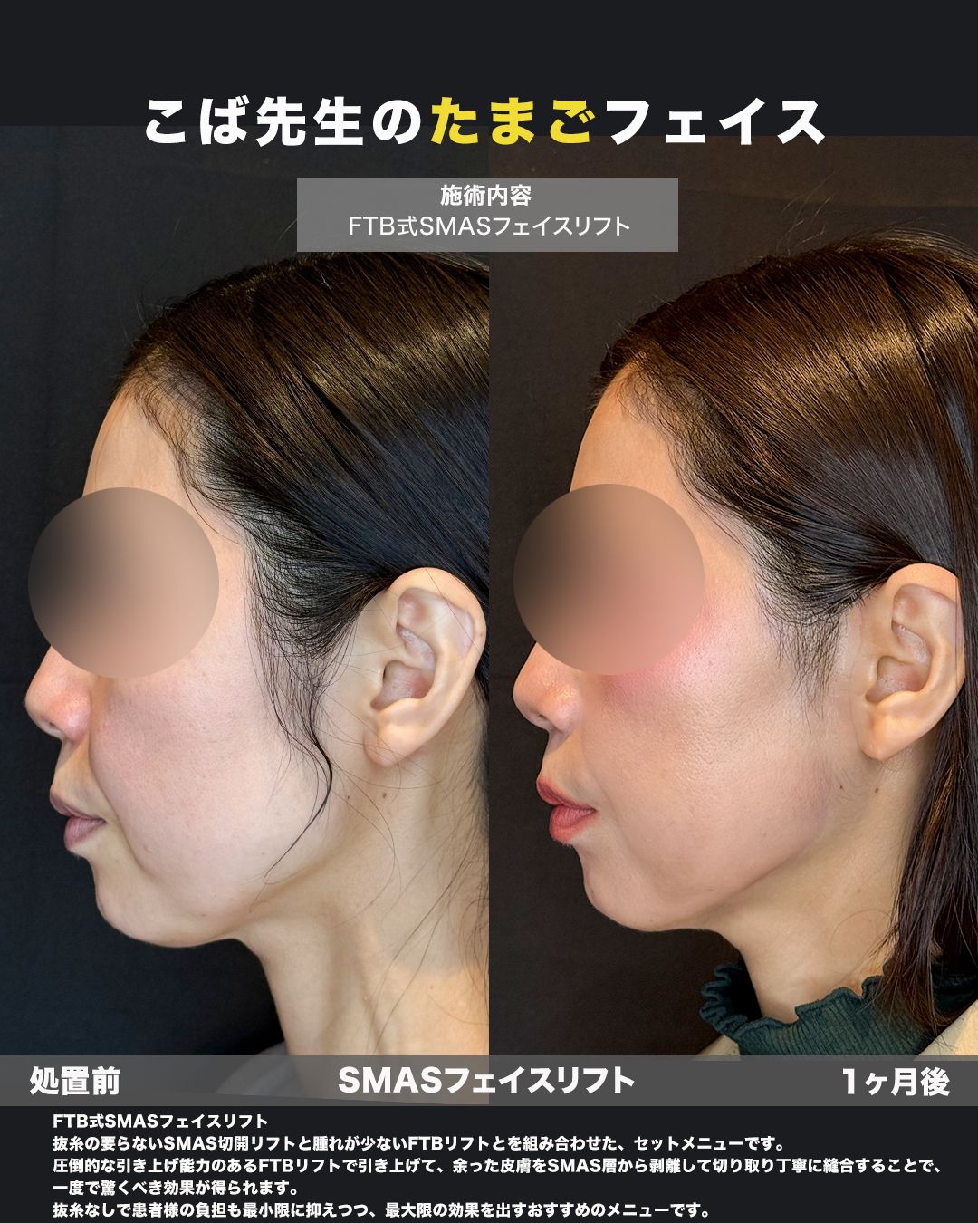 SMASフェイスリフトの症例。処置前と術後を横（側面）から並べた比較写真。