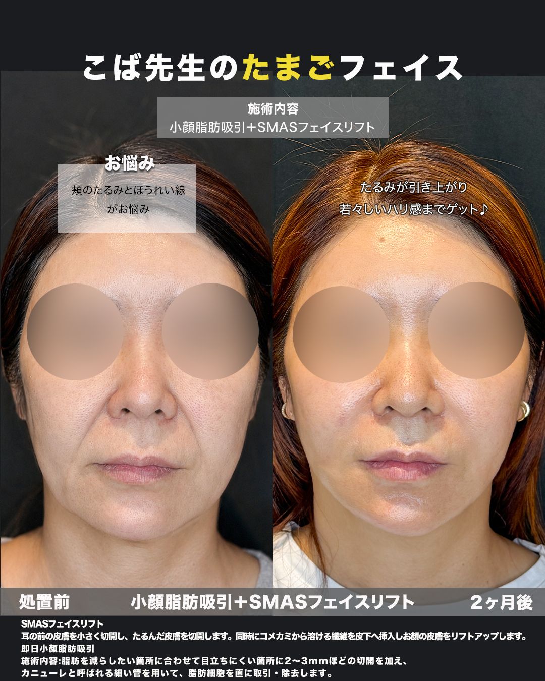 SMASフェイスリフト＋小顔脂肪吸引の症例。処置前と術後を正面から並べた比較写真。